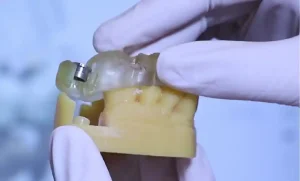 种植牙导航导板有什么优势