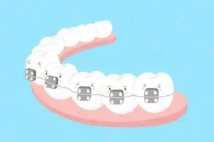 牙齿矫正期间如何清洁牙套