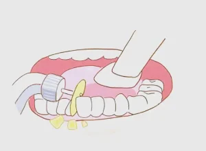 矫正牙齿必须拔牙吗