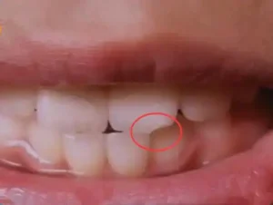 门牙磕掉一小块能直接补吗