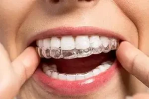 戴保持器要多久