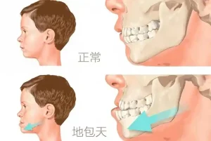 正颌手术风险大吗