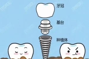 种植一颗大牙每年都要洗牙吗