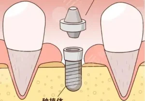 满口种植牙大概多少钱