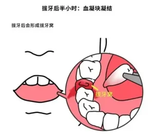 拔牙后血凝块脱落有什么症状