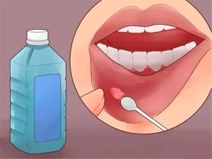 口舌生疮（口腔溃疡）怎么办