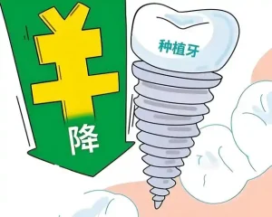 种植牙收费价目表